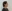 Lower Eyelid Fat Repositioning (transconjunctival) — Uri Plastic Surgery Clinic