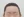Forehead reduction (hairline lowering surgery) — after (9days) · Goyu Plastic Surgery Clinic