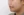 ตัดไขมันกระพุ้งแก้ม — ก่อนทำ (9วัน) · ไอรูมิ ศัลยกรรมพลาสติก