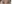 buried suture (non-incisional) double eyelid surgery — Hershey Plastic Surgery Clinic