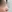 鼻尖形成術（自家軟骨移植） — アン美容外科クリニック
