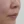 โบท็อกซ์ร่นร่องริมฝีปาก (Lip Flip ทำให้ร่องใต้จมูกดูสั้นลง) — ก่อนทำ (7วัน) · คลินิก Younme