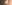 団子鼻修正（鼻尖縮小術） — ドクター美美容外科クリニック