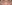 裏ハムラ法（経結膜的眼窩脂肪移動術） — ジャスト美容外科クリニック
