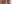 切開法（全切開法二重術） — Unique Plastic Surgery Clinic