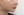 ตัดไขมันกระพุ้งแก้ม — หลังทำ (9วัน) · ไอรูมิ ศัลยกรรมพลาสติก