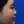 ผ่าตัดแก้ไขภาวะลิ้นจมูกตีบ/ยุบ (Nasal valve stenosis) — ก่อนทำ (30วัน) · บีเอส (BS) ซูมี โสต ศอ นาสิก