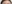 額（おでこ）の脂肪注入 — プレジャー美容外科クリニック