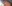 buried suture (non-incisional) double eyelid surgery — Uri Plastic Surgery Clinic