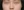 ตัดปีกจมูก (Alarplasty) — หลังทำ · คลินิกศัลยกรรม TJ (TJ Plastic Surgery)