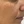 PRP skin rejuvenation (platelet-rich plasma therapy) — after (21days) · Only Lift Clinic