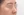 Paranasal (nasal base) augmentation with implant — after (14days) · iLumi Plastic Surgery Clinic