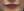 側臉頰填充（玻尿酸填補側臉頰凹陷） — 術前 · Cheongdam Dear 醫美診所