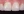 Composite resin filling — after · Yonsei Good Day Dental Clinic - Suseo Branch