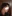 Bulbous nose correction (surgical nasal tip reduction) — DM Plastic Surgery Clinic