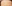 額縮小術（生え際下げ・ヘアライン下降術） — バタン美容外科クリニック