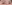 二重まぶた（自然癒着法） — ルホ美容外科クリニック