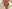 Double chin liposuction (submental liposuction) — Saegim Plastic Surgery Clinic