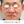 ウルセラプライム（Ultherapy PRIME） — 術前 · モンスタークリニック