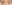 裏ハムラ法（経結膜的眼窩脂肪移動術） — ファクト美容外科クリニック