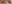 revision eyelid surgery (secondary blepharoplasty) — iNique Plastic Surgery & Aesthetics