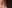 裏ハムラ法（経結膜的眼窩脂肪移動術） — アンド美容外科クリニック