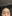 buried suture (non-incisional) double eyelid surgery — Chai Plastic Surgery