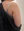Arm liposuction — before (2days) · Barbie Line Clinic
