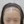 Scalp hair transplant — before (3days) · Vance Mosae Clinic