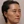Thread embedding acupuncture lift (Korean-medicine 'maeseon' acupoint thread lift) — after · Garoseo Oriental Clinic - Gangnam Branch