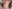 Masseter Botox (jaw slimming / square jaw reduction) — J.Fill Clinic - Gangnam Branch