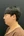 頬の脂肪吸引 — 術前 (7日) · 江南アジュールクリニック