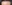 額縮小術（生え際下げ・ヘアライン下降術） — ザフィックス美容外科クリニック