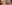 二重まぶた（自然癒着法） — プロミス美容外科クリニック