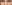 裏ハムラ法（経結膜的眼窩脂肪移動術） — Renew Up Plastic Surgery Clinic
