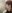 貴族手術（鼻翼基部プロテーゼ／鼻基底形成） — アーバン美容外科クリニック