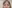 Forehead Lift (brow lift, commonly endoscopic) — Uri Plastic Surgery Clinic