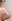 鼻尖形成術（自家軟骨移植） — グナル美容外科クリニック