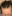 Scalp hair transplant — Mo&Line Plastic Surgery