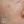 RevLite SI (Q-switched Nd:YAG laser toning) — before (60days) · A-Top Plastic Surgery Clinic
