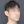 two-jaw surgery (bimaxillary orthognathic surgery) — before (40days) · ReFace Dental Hospital