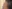 額（おでこ）のヒアルロン酸注入 — フルルン美容外科クリニック
