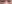 裏ハムラ法（経結膜的眼窩脂肪移動術） — ジェスタ美容外科クリニック