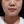 Ultraformer MPT (อัลตร้าฟอร์เมอร์ เอ็มพีที) — ก่อนทำ · คลินิกรีไฟน์
