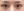 incisional double eyelid surgery — after (7days) · iLumi Plastic Surgery Clinic