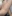 Potenza RF microneedling — Better Me Clinic - Gangnam
