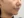 ยกกระชับ V-shape ด้วย HIFU (Shurink / Ultraformer III) — หลังทำ (30วัน) · Monster Clinic