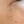 จี้หูด / กำจัดหูด (CO2 laser, จี้เย็น) — ก่อนทำ (14วัน) · โอริเฟซ ซองโด คลินิกฮอไรซัน