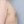 男性乳房发育症非手术治疗（冷冻溶脂/溶脂针） — 术后 (60天) · Abeque医美诊所