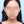ผ่าตัดลดโหนกแก้มแบบเร็ว (ไม่ใส่ตัวยึด) — หลังทำ (90วัน) · ยูโนพลาสติกเซอร์เจอรี่